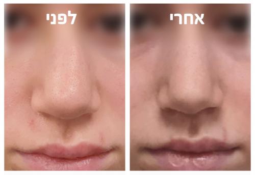 - ניתוח אף פלסטי אסתטי משולב עם רפואי - Rhinoplasty | דוקטור שי דובדבני