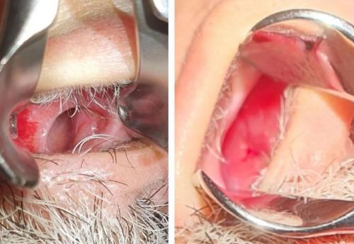 close-hole סגירת נקב במחיצת האף | דוקטור שי דובדבני