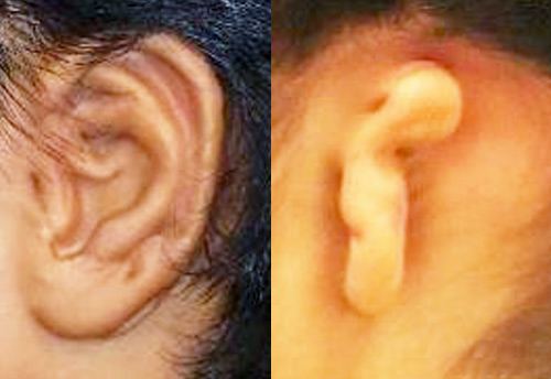 microtia ניתוח אף אוזן גרון | דר דובדבני שי