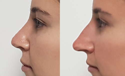 revision_nose ניתוח הקטנת / הצמדת אוזניים - Otoplasty | דוקטור שי דובדבני