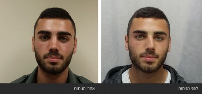 ---4 ניתוח אף - Rhinoplasty | דוקטור שי דובדבני