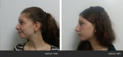 ---6 ניתוח אף - Rhinoplasty | דוקטור שי דובדבני