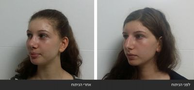 ---61 ניתוח אף - Rhinoplasty | דוקטור שי דובדבני