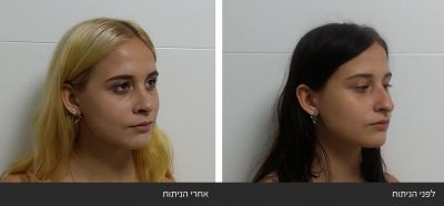 ---7 ניתוח אף פלסטי אסתטי משולב עם רפואי - Rhinoplasty | דוקטור שי דובדבני