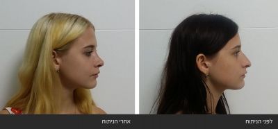 ---71 ניתוח אף - Rhinoplasty | דוקטור שי דובדבני