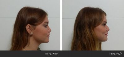 ---8 ניתוחי אף פלסטי אסתטי משולב עם רפואי