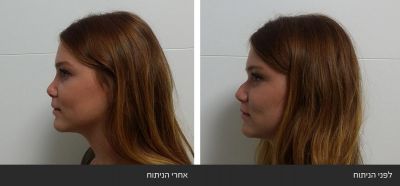 ---81 ניתוח אף פלסטי אסתטי משולב עם רפואי - Rhinoplasty | דוקטור שי דובדבני