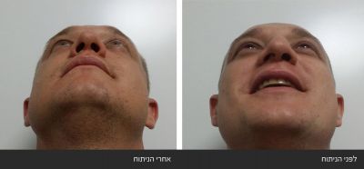 ---9 ניתוח אף פלסטי אסתטי משולב עם רפואי - Rhinoplasty | דוקטור שי דובדבני