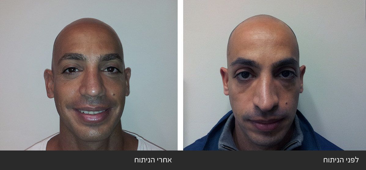 תיקון ניתוח אף ארוך ועקום תיקון ניתוח אף ארוך ועקום