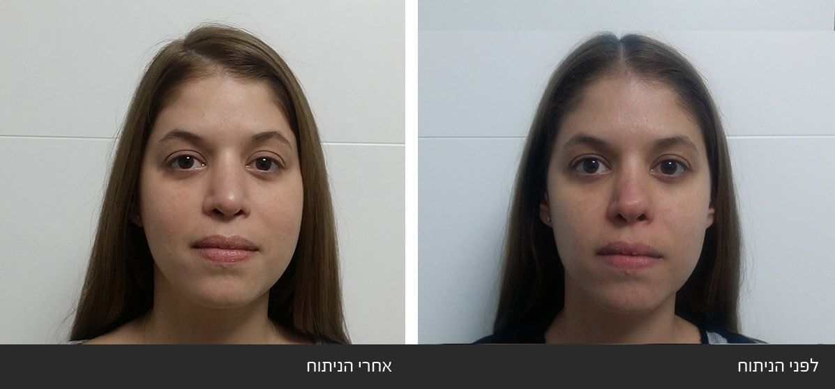 תיקון ניתוח אף כושל של קצה האף ואי סדירות בגשר האף תיקון ניתוח אף כושל של קצה האף ואי סדירות בגשר האף