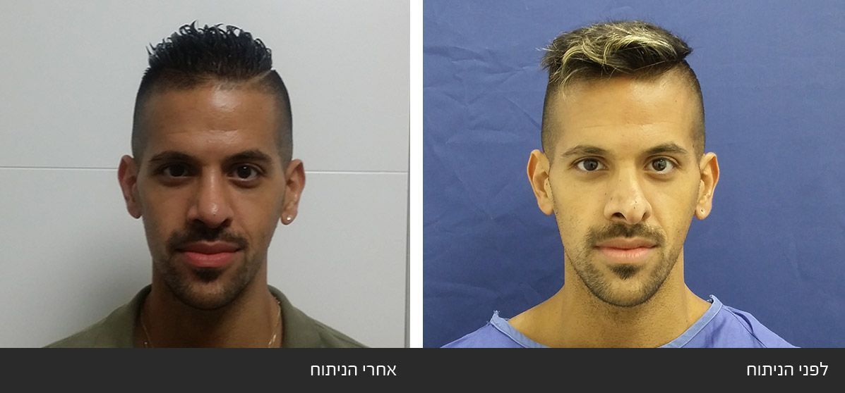 ------------4 image ------------4 ניתוח אף חוזר - תיקון אף לאחר ניתוח כושל - Revision Rhinoplasty | דוקטור שי דובדבני