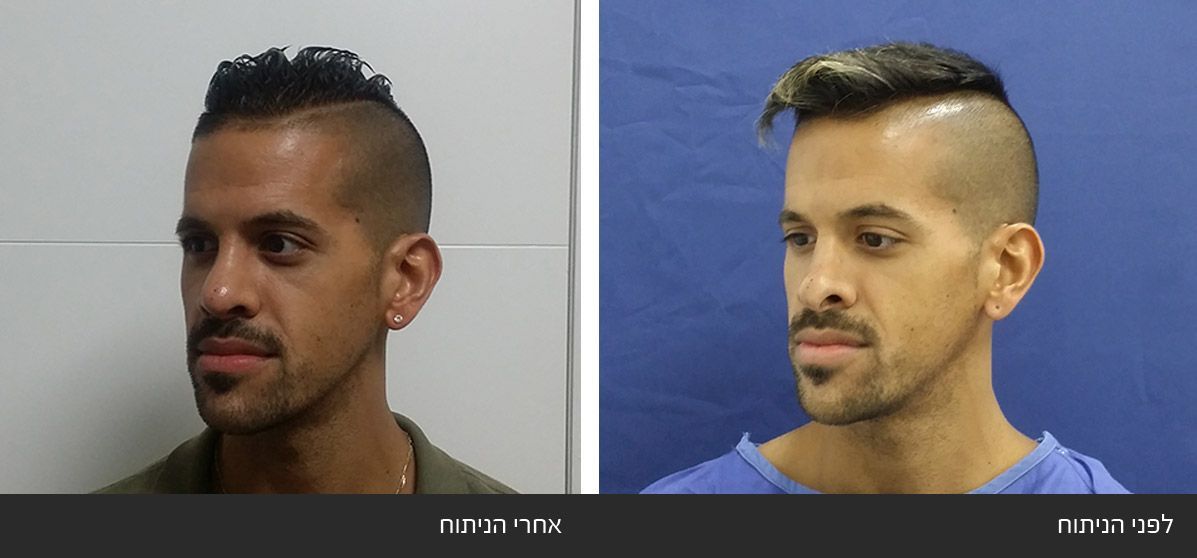 ------------42 image ------------42 ניתוח אף חוזר - תיקון אף לאחר ניתוח כושל - Revision Rhinoplasty | דוקטור שי דובדבני
