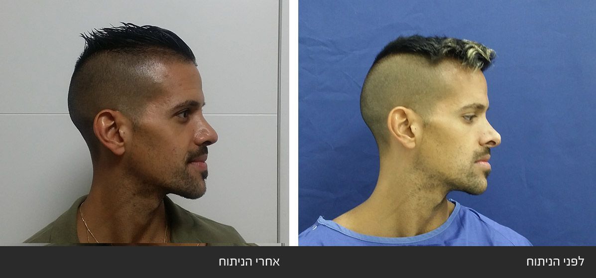 ------------43 image ------------43 ניתוח אף חוזר - תיקון אף לאחר ניתוח כושל - Revision Rhinoplasty | דוקטור שי דובדבני