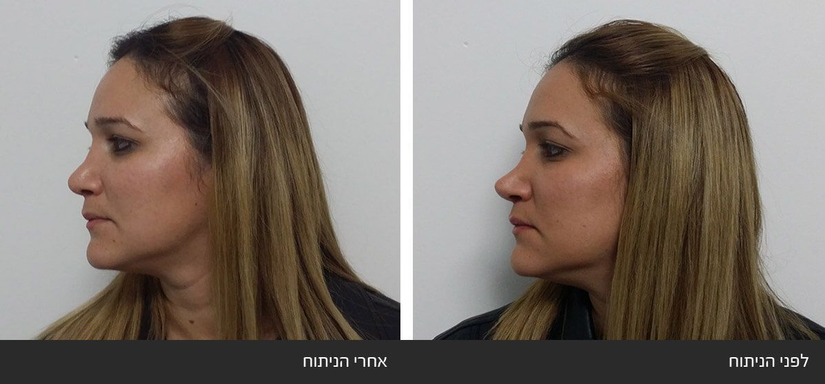 תיקון ניתוח אף ארוך ושקוע תיקון ניתוח אף ארוך ושקוע