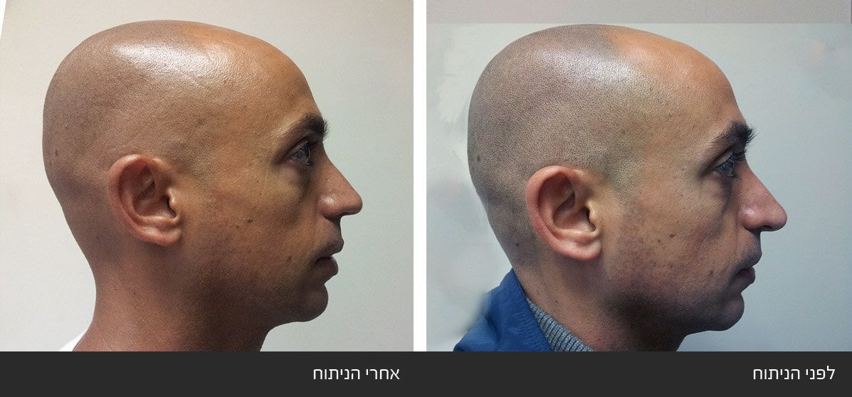 תיקון ניתוח אף ארוך ועקום תיקון ניתוח אף ארוך ועקום