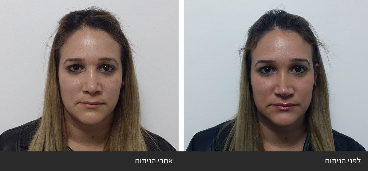 תיקון ניתוח אף ארוך ושקוע תיקון ניתוח אף ארוך ושקוע