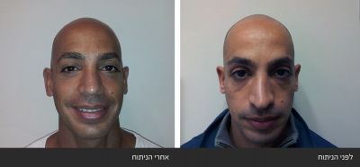 תיקון ניתוח אף ארוך ועקום