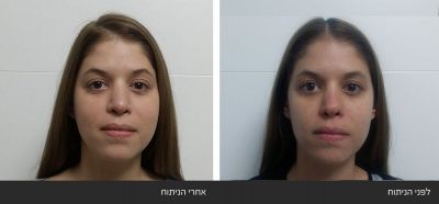 תיקון ניתוח אף כושל של קצה האף ואי סדירות בגשר האף