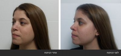 תיקון ניתוח אף כושל של קצה האף ואי סדירות בגשר האף