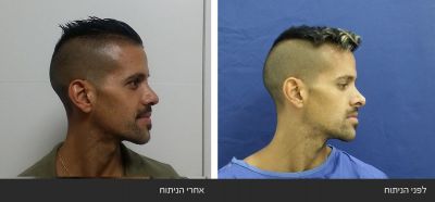 ------------43 גלריית תמונות - ניתוח אף חוזר | דוקטור שי דובדבני