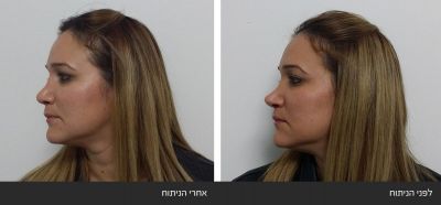 תיקון ניתוח אף ארוך ושקוע