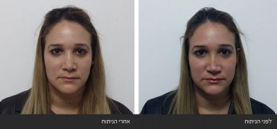 תיקון ניתוח אף ארוך ושקוע